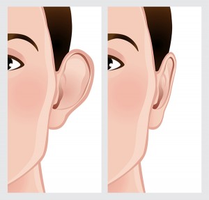 An otoplasty procedure can help reshape the ears to achieve a more natural shape.