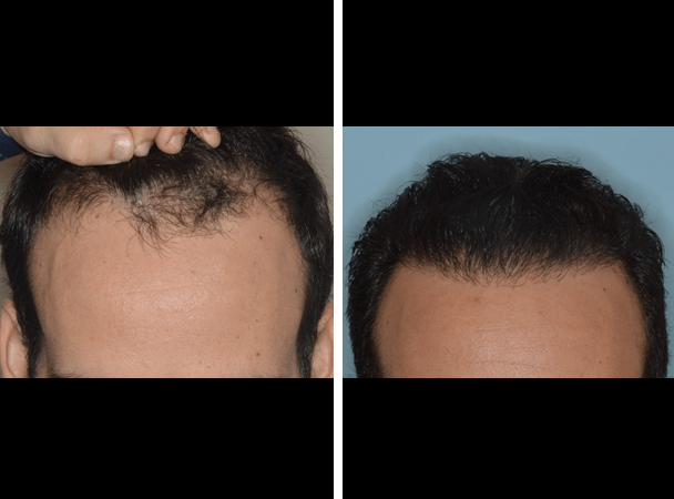 Hair Transplant - Miami Facial Plastic Surgery - Dr. Bared Hair Transplant - Miami Facial Plastic Surgery - Dr. Bared