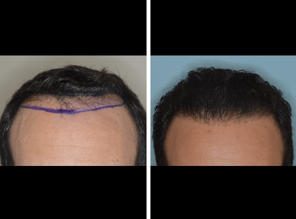 Before and After 2 | Hair Transplant | Miami