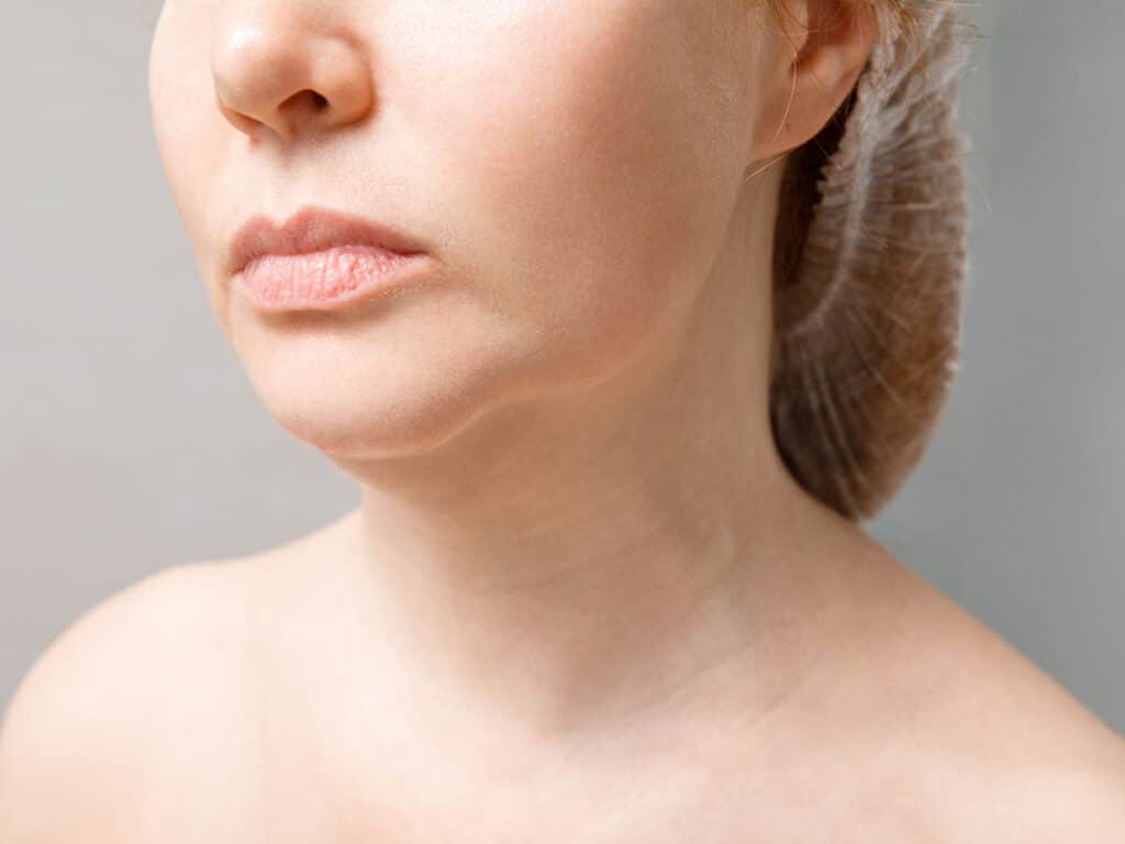 Candidates with naturally-occurring buccal fat pads are ideal candidates for cheek reduction surgery.