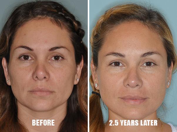Revision Rhinoplasty Before and After Photos in Miami, FL, Patient 792
