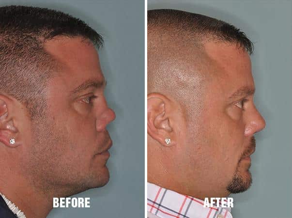 The patient has a history that includes nasal trauma and previous rhinoplasty. A synthetic implant was used in the previous rhinoplasty which extruded through his nasal tip. Rib cartilage was used to rebuild his nasal dorsum.