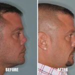 Revision Rhinoplasty Before and After Photos in Miami, FL, Patient 822