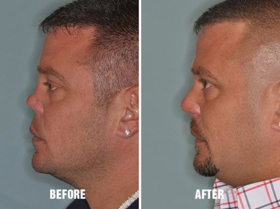 Revision Rhinoplasty Before and After Photos in Miami, FL, Patient 822