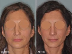 Revision Rhinoplasty Before and After Photos in Miami, FL, Patient 827