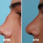 Revision Rhinoplasty Before and After Photos in Miami, FL, Patient 769