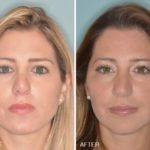 Revision Rhinoplasty Before and After Photos in Miami, FL, Patient 840