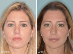 Revision Rhinoplasty Before and After Photos in Miami, FL, Patient 840