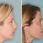 Revision Rhinoplasty Before and After Photos in Miami, FL, Patient 840