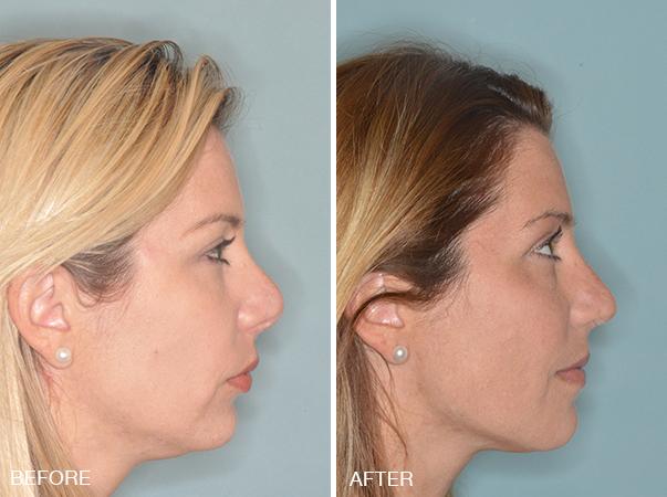 Revision Rhinoplasty Before and After Photos in Miami, FL, Patient 840