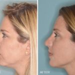 Revision Rhinoplasty Before and After Photos in Miami, FL, Patient 840