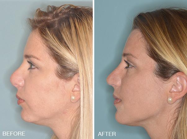 Revision Rhinoplasty Before and After Photos in Miami, FL, Patient 840