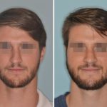 Revision Rhinoplasty Before and After Photos in Miami, FL, Patient 850