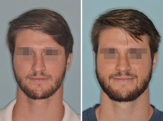 Revision Rhinoplasty Before and After Photos in Miami, FL, Patient 850