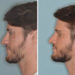 Revision Rhinoplasty Before and After Photos in Miami, FL, Patient 850