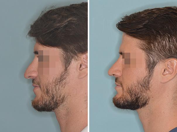 Revision Rhinoplasty Before and After Photos in Miami, FL, Patient 850