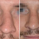 Revision Rhinoplasty Before and After Photos in Miami, FL, Patient 850