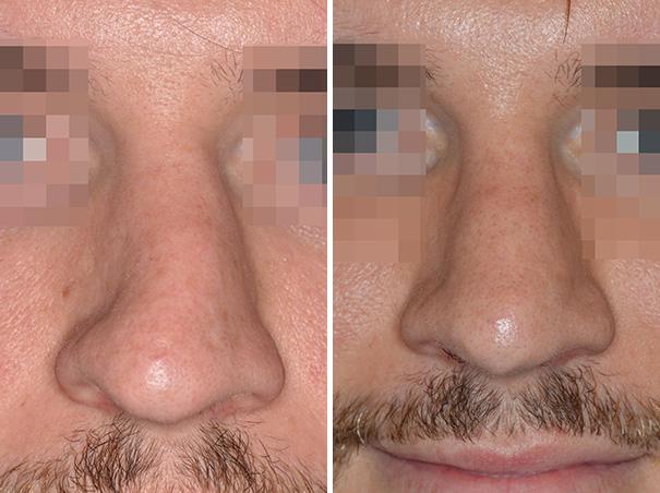 Revision Rhinoplasty Before and After Photos in Miami, FL, Patient 850