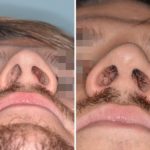 Revision Rhinoplasty Before and After Photos in Miami, FL, Patient 850