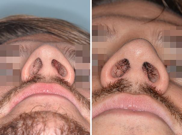 Revision Rhinoplasty Before and After Photos in Miami, FL, Patient 850
