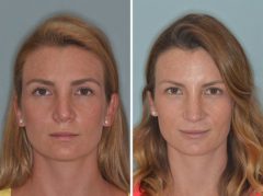 Revision Rhinoplasty Before and After Photos in Miami, FL, Patient 863