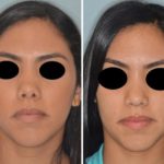 Revision Rhinoplasty Before and After Photos in Miami, FL, Patient 876