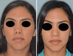 Revision Rhinoplasty Before and After Photos in Miami, FL, Patient 876