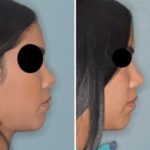 Revision Rhinoplasty Before and After Photos in Miami, FL, Patient 876