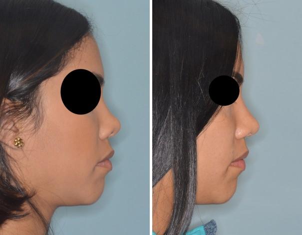 Revision Rhinoplasty Before and After Photos in Miami, FL, Patient 876