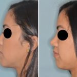 Revision Rhinoplasty Before and After Photos in Miami, FL, Patient 876