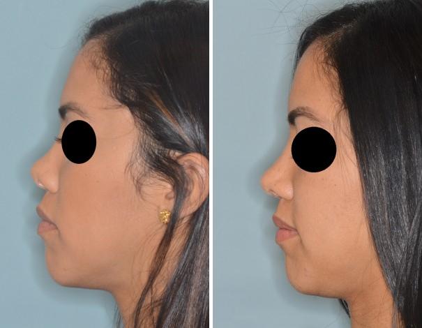 Revision Rhinoplasty Before and After Photos in Miami, FL, Patient 876
