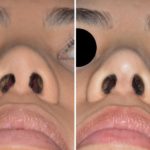 Revision Rhinoplasty Before and After Photos in Miami, FL, Patient 876
