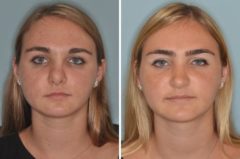 Revision Rhinoplasty Before and After Photos in Miami, FL, Patient 900