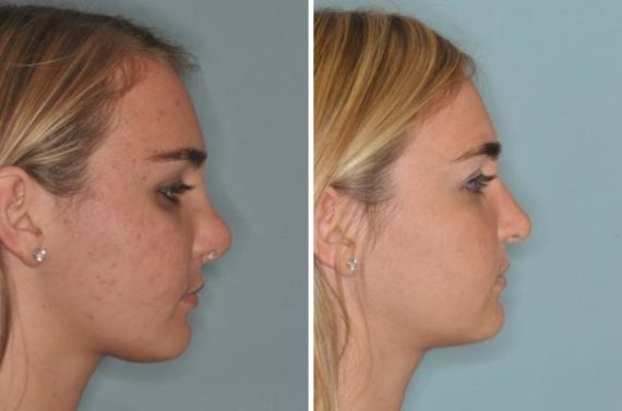 Revision Rhinoplasty Before and After Photos in Miami, FL, Patient 900