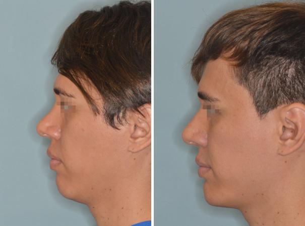 Patient 920, Revision Rhinoplasty Before and After Photos Revision Rhinoplasty Before and After Photos in Miami, FL, Patient 920