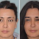 Revision Rhinoplasty Before and After Photos in Miami, FL, Patient 927