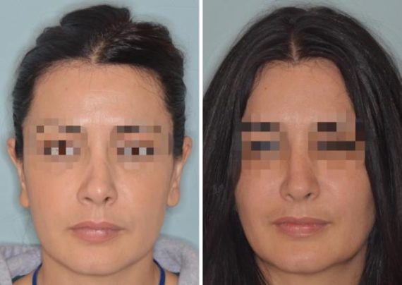 Revision Rhinoplasty Before and After Photos in Miami, FL, Patient 927