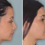 Revision Rhinoplasty Before and After Photos in Miami, FL, Patient 927