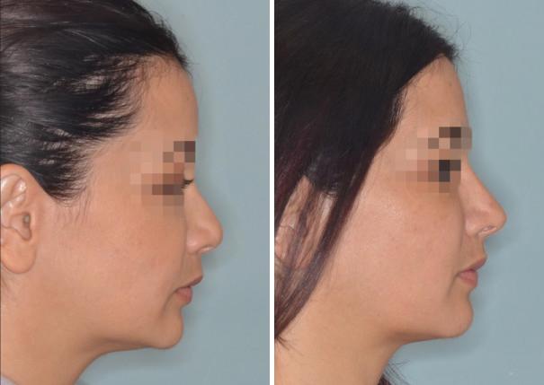 Revision Rhinoplasty Before and After Photos in Miami, FL, Patient 927