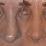 Revision Rhinoplasty Before and After Photos in Miami, FL, Patient 944