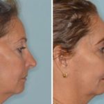 Revision Rhinoplasty Before and After Photos in Miami, FL, Patient 944