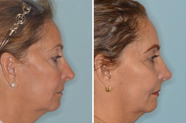 Revision Rhinoplasty Before and After Photos in Miami, FL, Patient 944