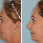 Revision Rhinoplasty Before and After Photos in Miami, FL, Patient 944