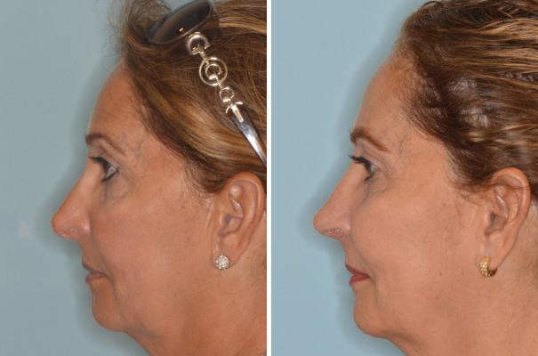 Revision Rhinoplasty Before and After Photos in Miami, FL, Patient 944