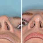 Revision Rhinoplasty Before and After Photos in Miami, FL, Patient 944