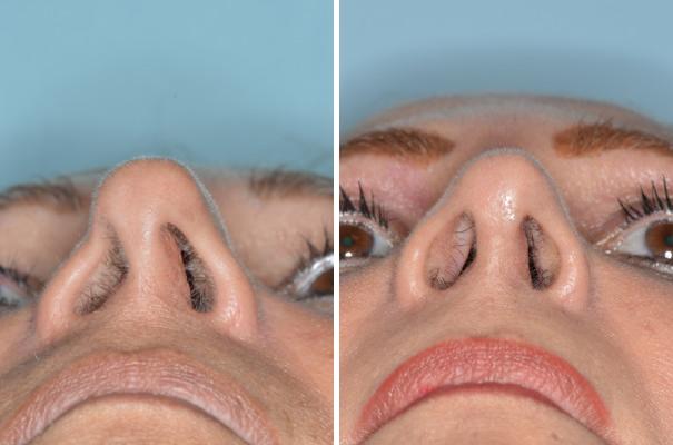 Revision Rhinoplasty Before and After Photos in Miami, FL, Patient 944