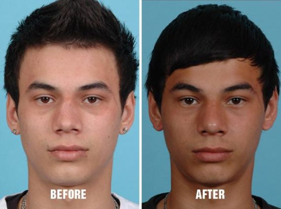 Revision Rhinoplasty Before and After Photos in Miami, FL, Patient 769