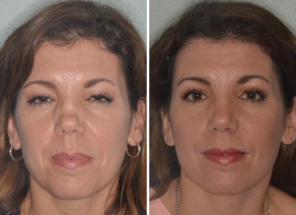 Patient 960, Revision Rhinoplasty Before and After Photos Revision Rhinoplasty Before and After Photos in Miami, FL, Patient 960