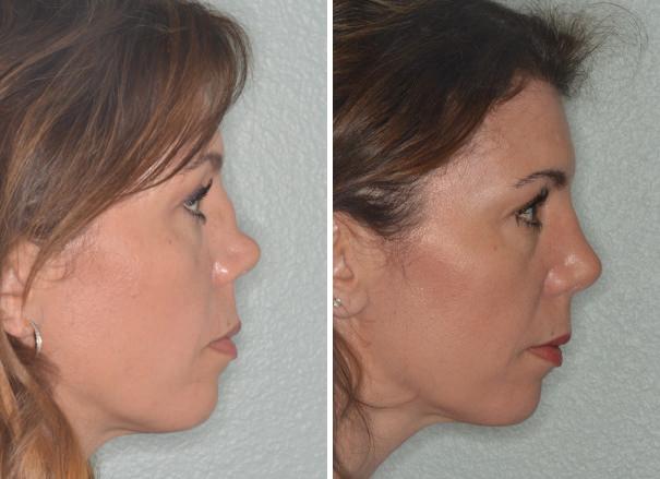 Patient 960, Revision Rhinoplasty Before and After Photos Revision Rhinoplasty Before and After Photos in Miami, FL, Patient 960