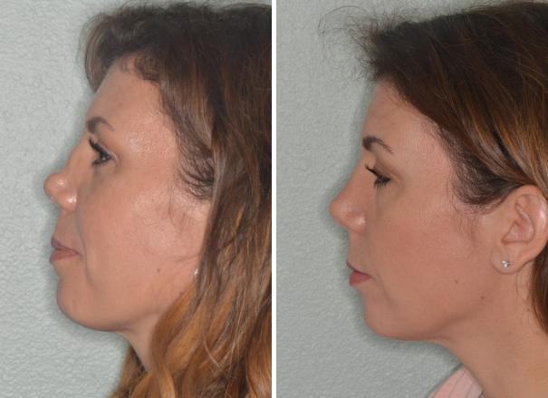 Patient 960, Revision Rhinoplasty Before and After Photos Revision Rhinoplasty Before and After Photos in Miami, FL, Patient 960